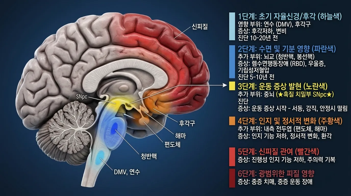 브라크 병기 6단계 — 알파-시뉴클레인의 뇌 내 확산